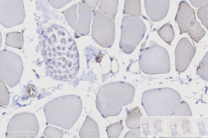 Hindlimb ischemia