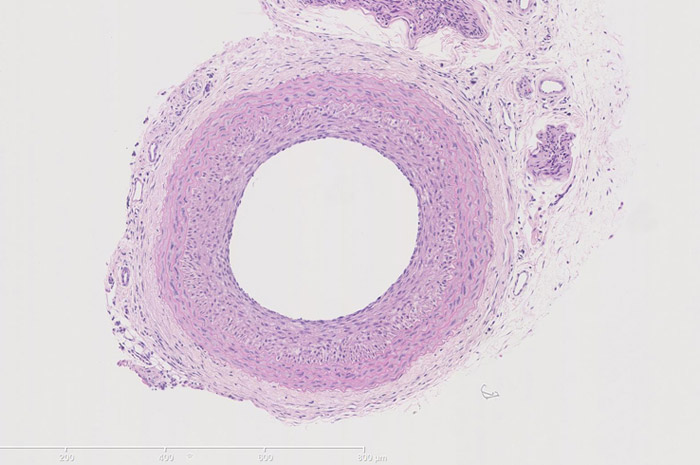 LCA 14 days after surgery